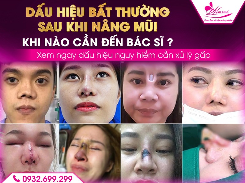 dau-hieu-bat-thuong-sau-nang-mui