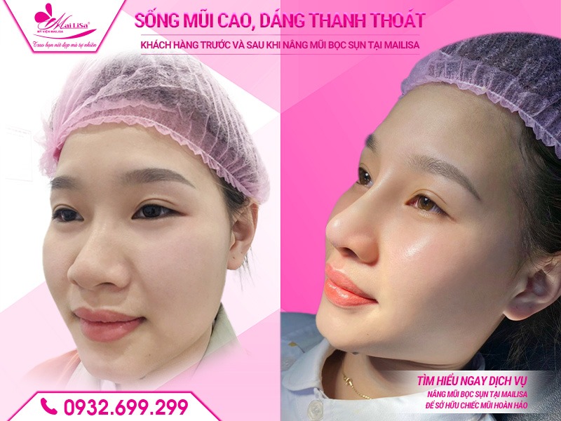 phau-thuat-nang-mui-keo-dai-bao-lau