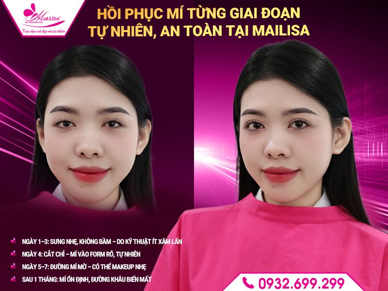 qua-trinh-hoi-phuc-sau-khi-cat-mi