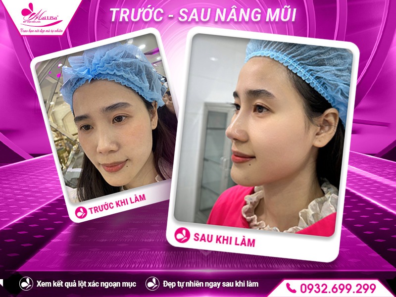 sau-nang-mui-bao-lau-thi-het-sung