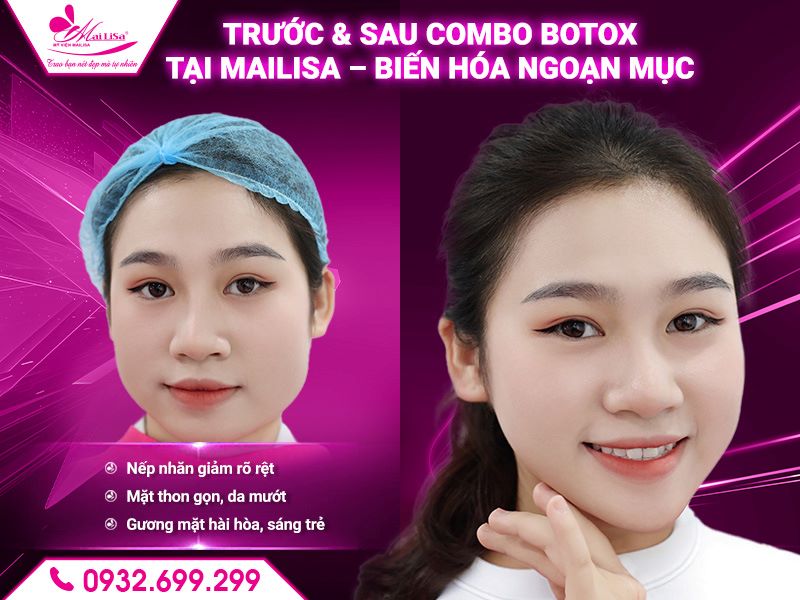 before-after-tiem-botox-mailisa