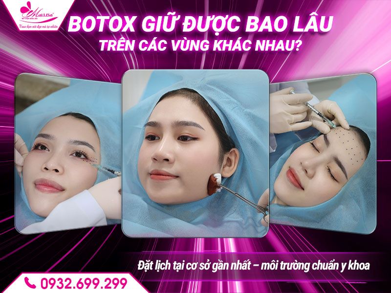 botox-giu-duoc-bao-lau-tren-cac-vung-khac-nhau