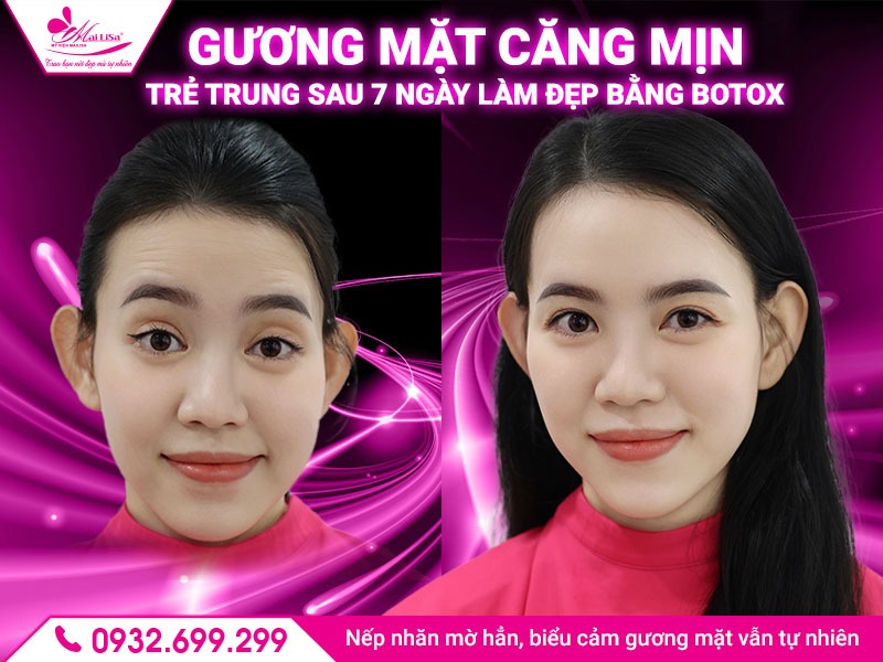 botox-tri-nep-nhan