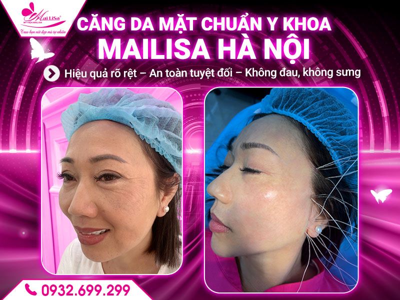cang-da-mat-chuan-y-khoa-mailisa-ha-noi