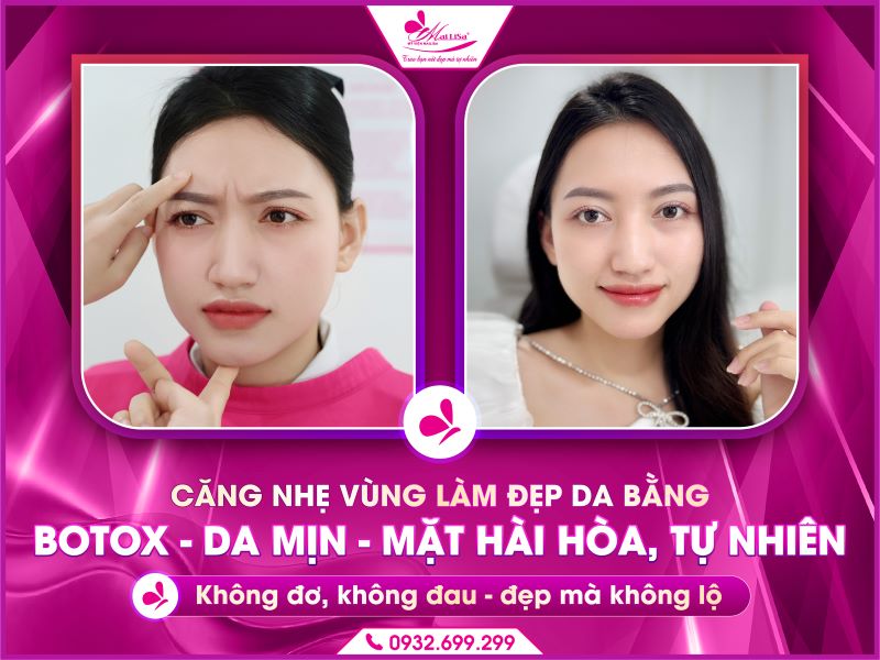 cang-nhe-vung-lam-dep-da-bang-botox