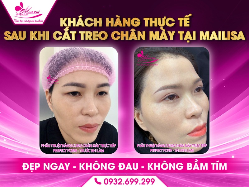 cham-soc-sau-khi-cat-treo-de-khong-bi-seo