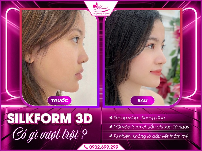 cong-nghe-silkform-3d-tai-mailisa