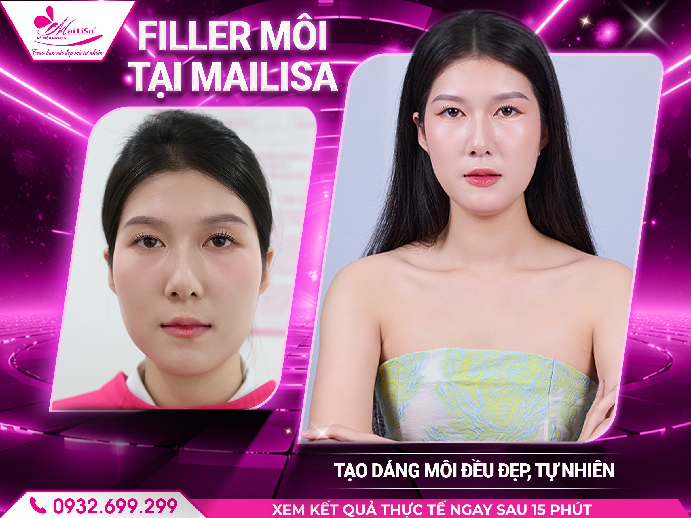 mailisa-co-lam-dep-bang-filler-khong