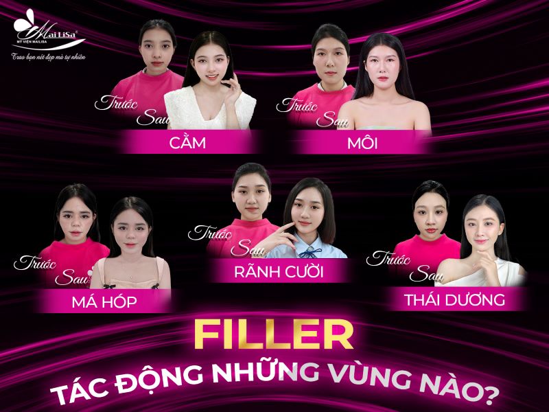 filler-tac-dong-nhung-vung-nao