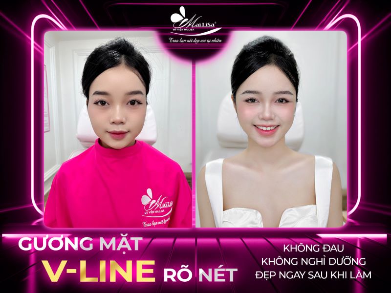guong-mat-v-line-ro-net