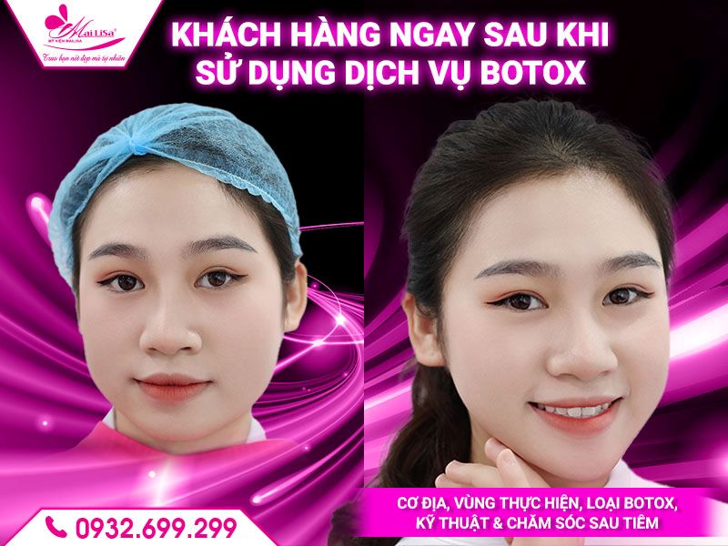 khach-hang-ngay-sau-khi-su-dung-dich-vu-botox