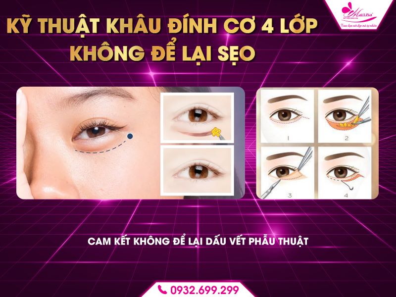 ky-thuat-khau-dinh-co-4-lop-khong-de-lai-seo