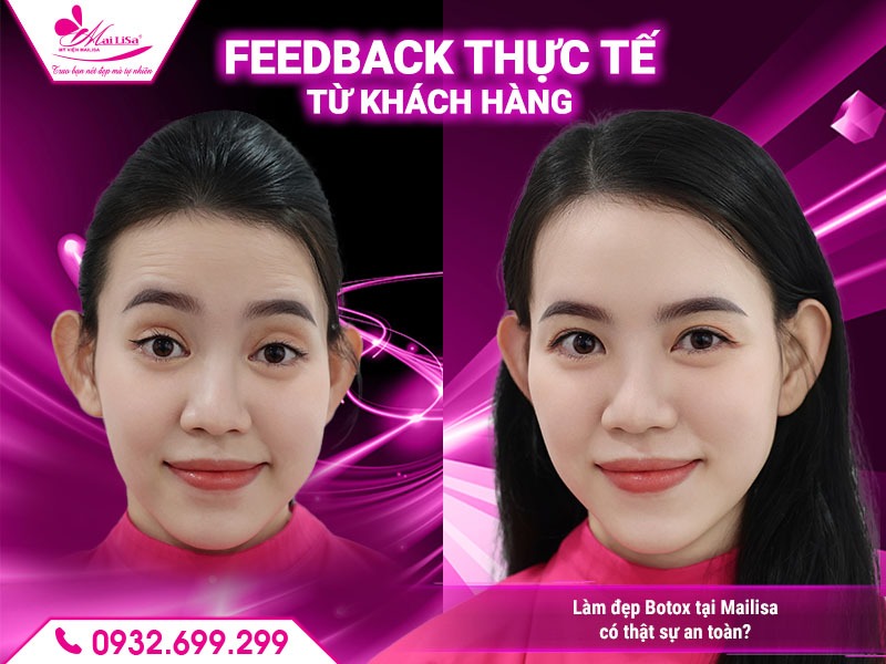 lam-dep-botox-o-dau-dep-va-an-toan