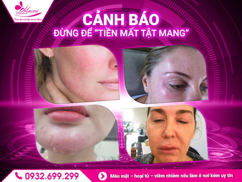 lam-dep-botox-o-dau-dep-va-an-toan
