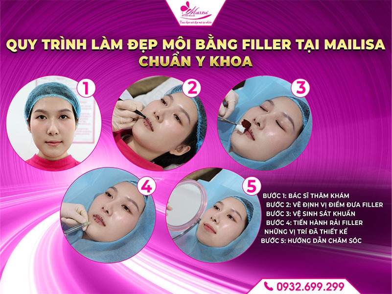 lam-dep-filler-moi