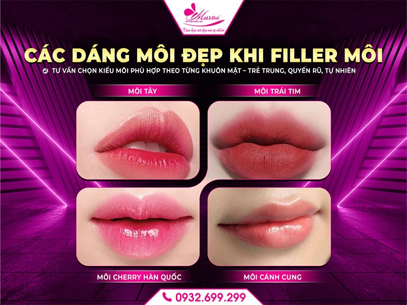 lam-dep-filler-moi