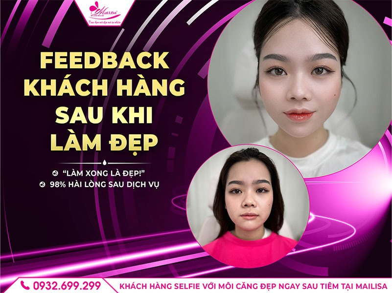 lam-dep-filler-moi-bao-lau-thi-dep