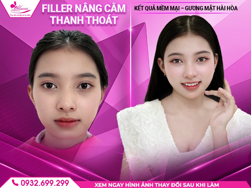 mailisa-co-lam-dep-bang-filler-khong