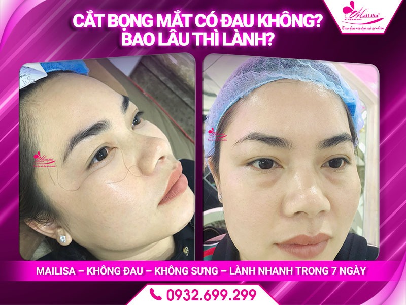 phau-thuat-cat-bong-mat-la-gi
