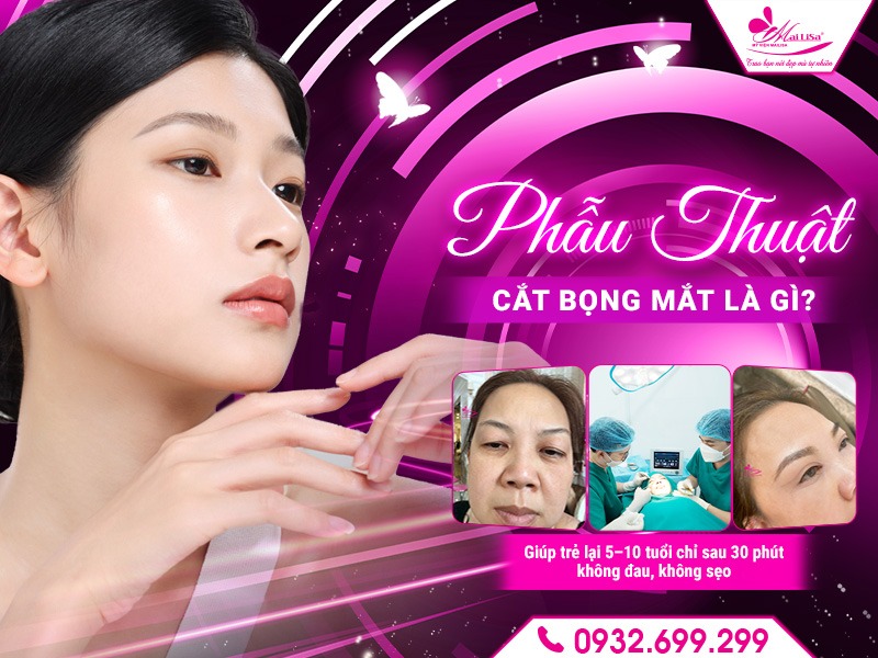 phau-thuat-cat-bong-mat-la-gi