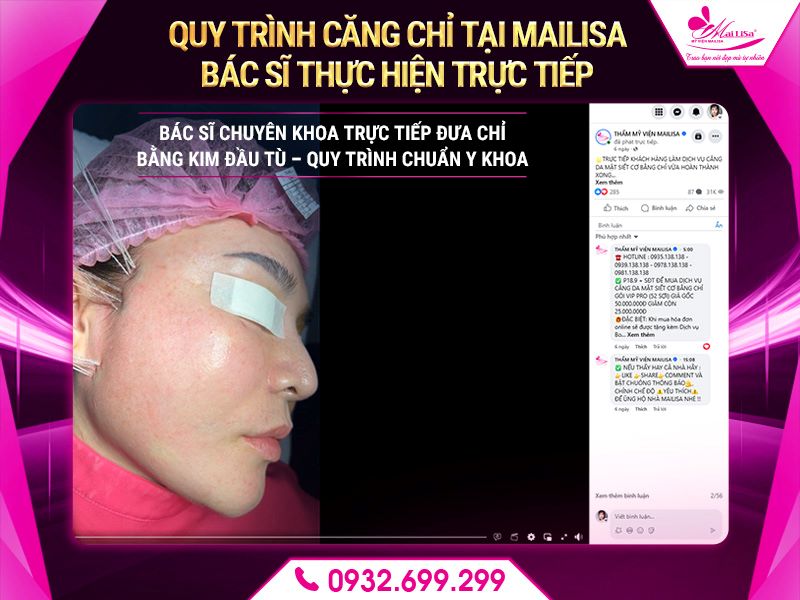 quy-trinh-cang-chi-tai-mailisa