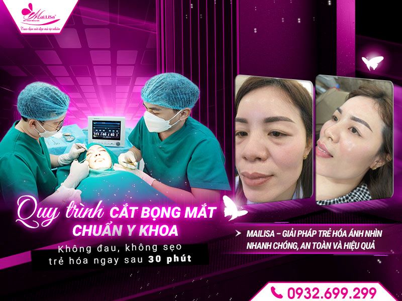 quy-trinh-cat-bong-mat-chuan-y-khoa