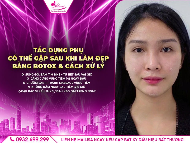 https://mailisa.com quy trình làm đẹp botox chuẩn y khoa, an toàn tại mailisa