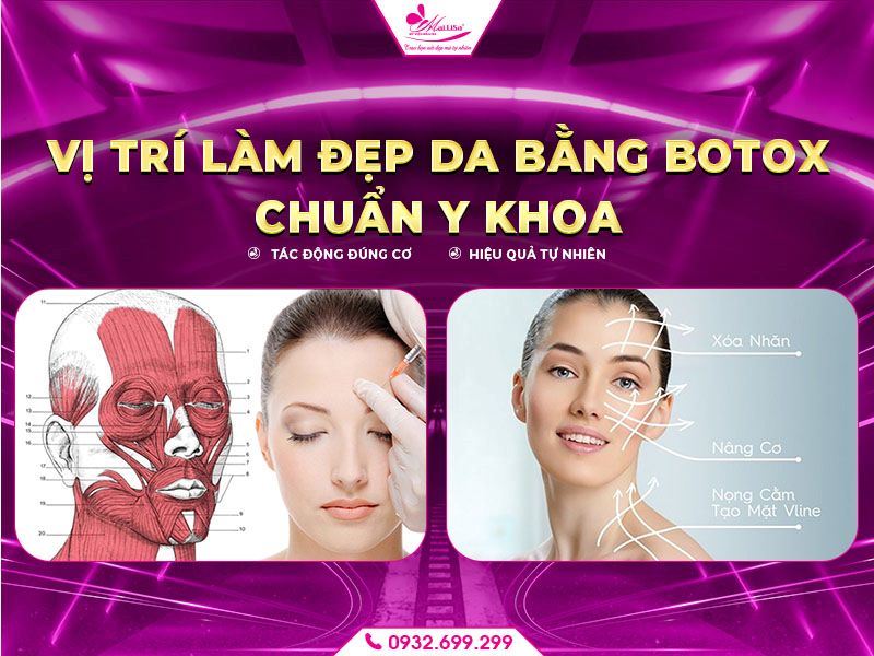 vi-tri-lam-dep-da-bang-botox-chuan-y-khoa