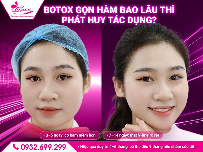 botox-gon-ham-bao-lau-thi-phat-huy-tac-dung