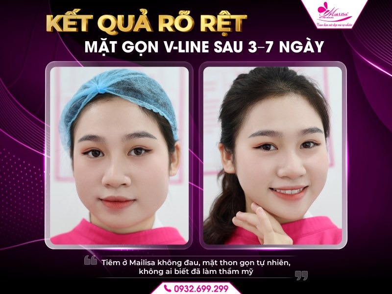 botox-gon-ham-co-can-dam-lai-khong