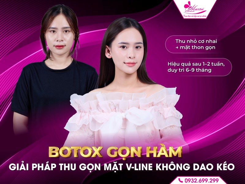 botox-gon-ham-giai-phap-thu-gon-mat
