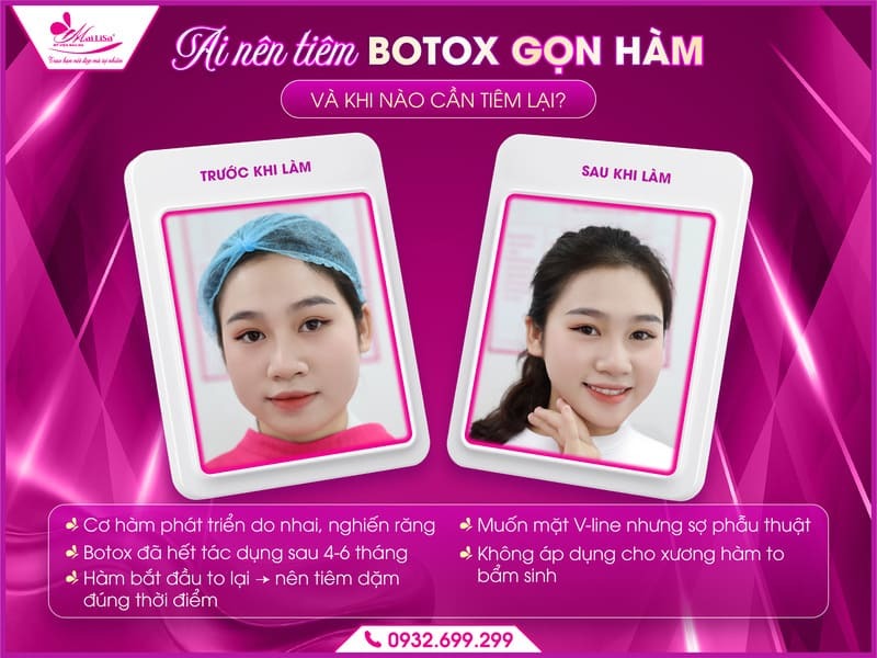 https://mailisa.com botox-gon-ham-giu-duoc-bao-lau