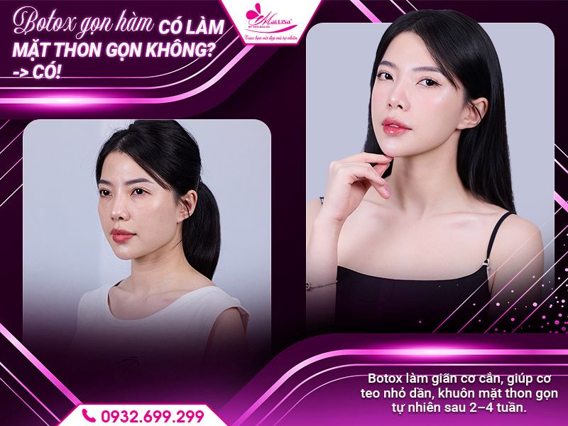 botox-gon-ham-hieu-qua-v-line