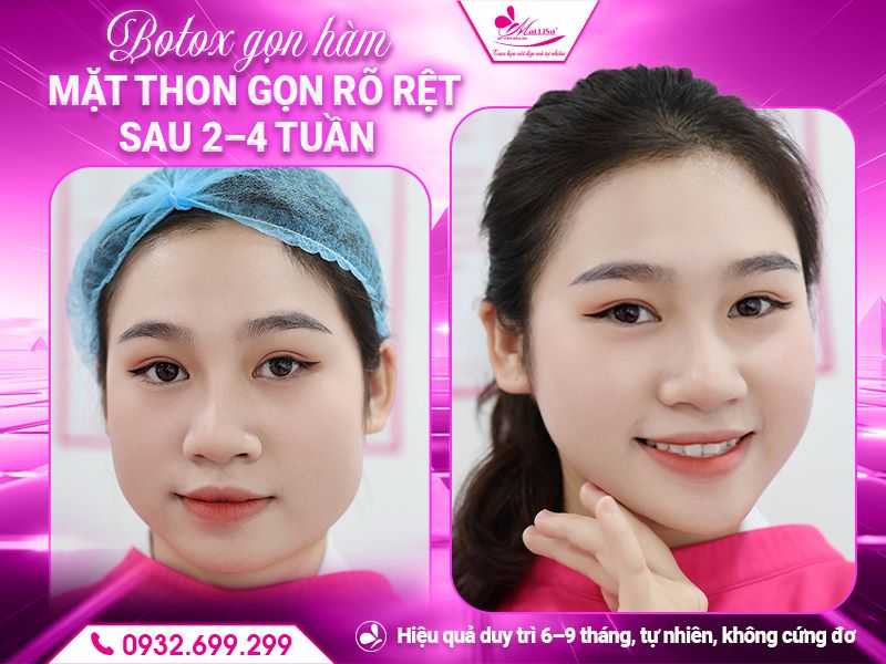 botox-gon-ham-mat-thon-gon-ro-ret