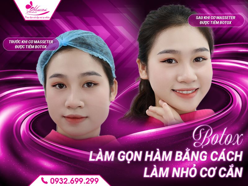 botox-lam-gon-ham-bang-cach-lam-nho-co-can