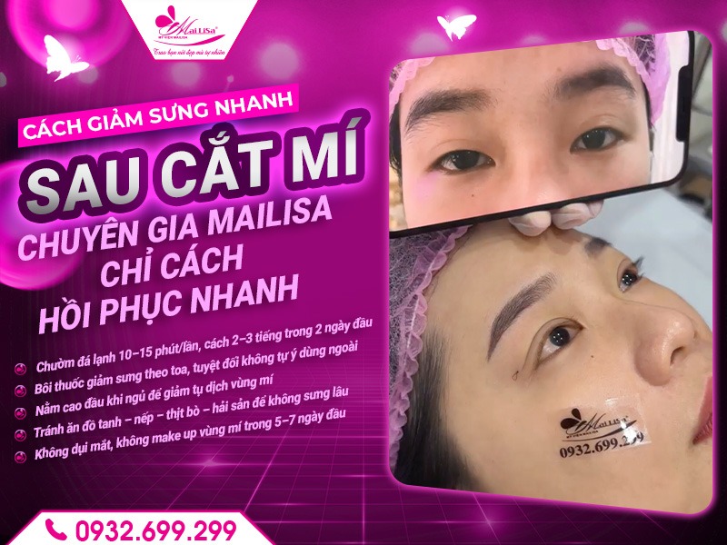 cach-giam-sung-nhanh-sau-cat-mi