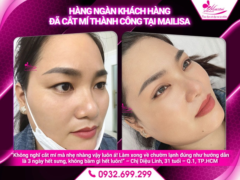 cach-giam-sung-nhanh-sau-cat-mi