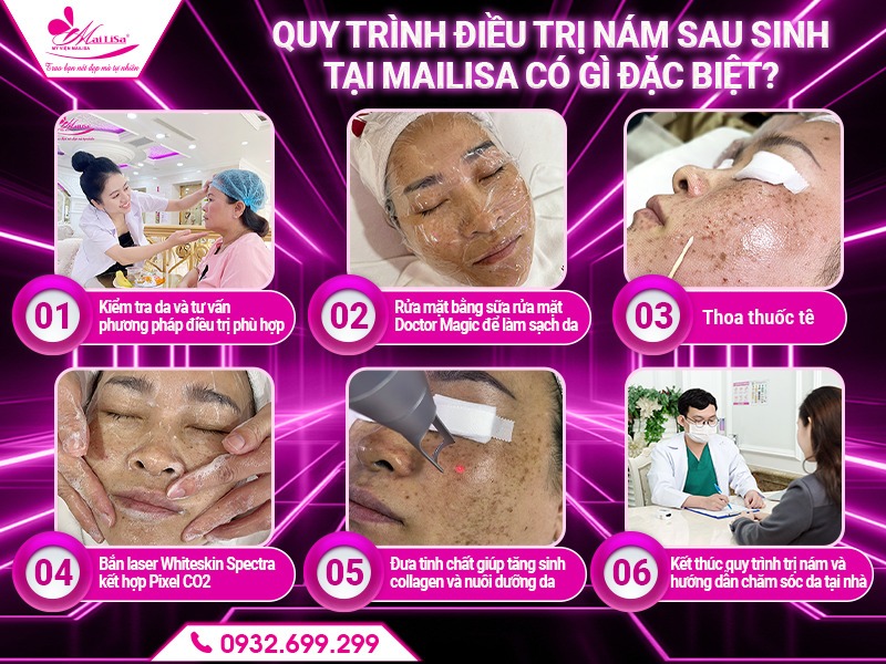 cong-nghe-tri-nam-cho-phu-nu-sau-sinh