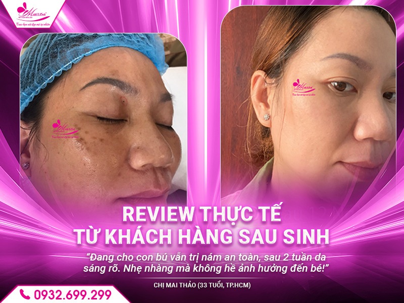 cong-nghe-tri-nam-cho-phu-nu-sau-sinh
