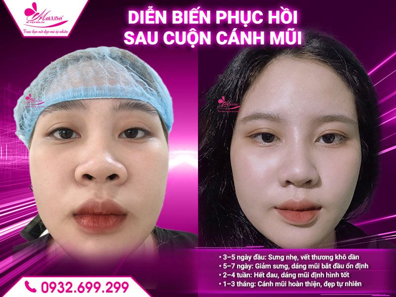dien-bien-phuc-hoi-sau-cuon-canh-mui