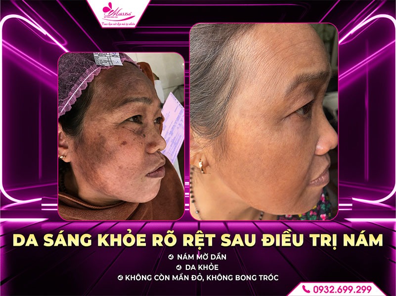dieu-tri-nam-cho-da-nhay-cam