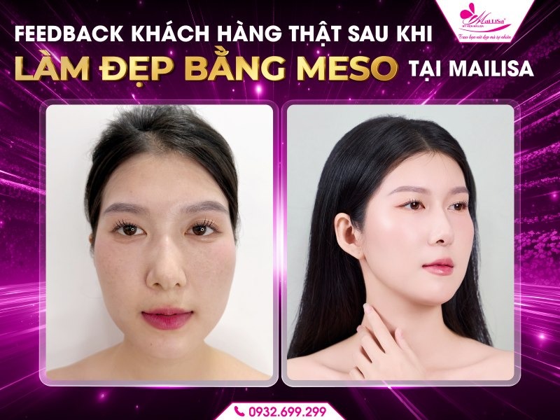 lam-dep-bang-meso-co-dau-khong