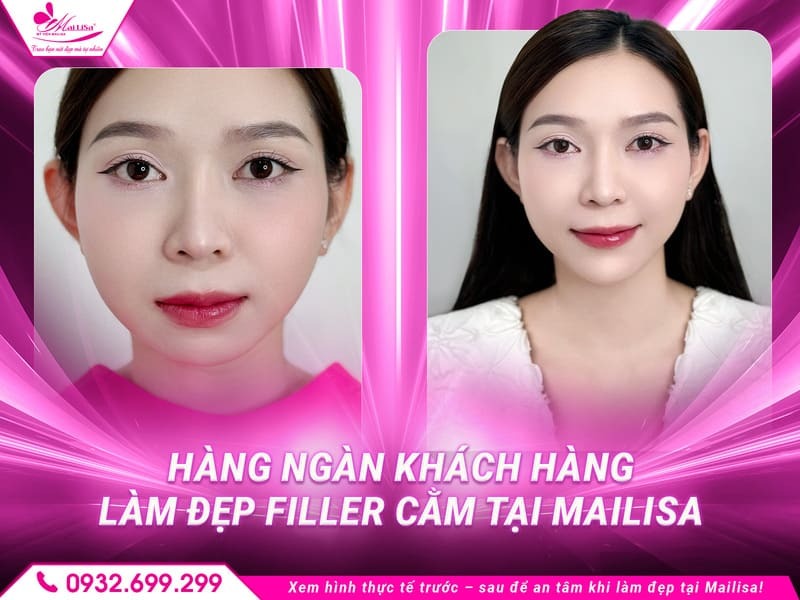 filler-cam-bao-lau-thi-dep