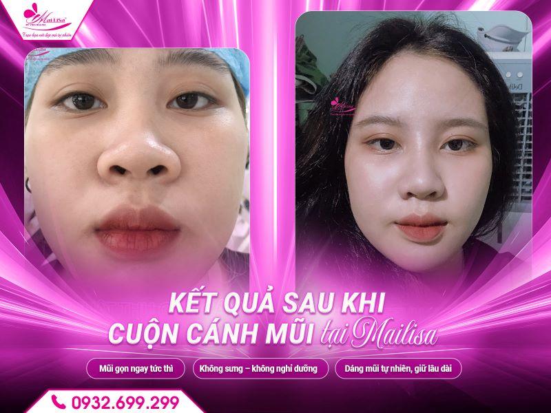 ket-qua-sau-khi-cuon-canh-mui-tai-mailisa