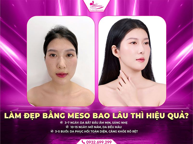 lam-dep-bang-meso-bao-lau-thi-hieu-qua