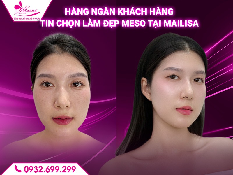 lam-dep-da-bang-meso-co-gay-kich-ung-khong