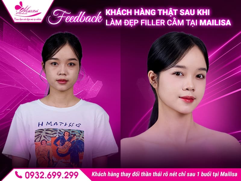 lam-dep-filler-cam-co-an-toan-khong