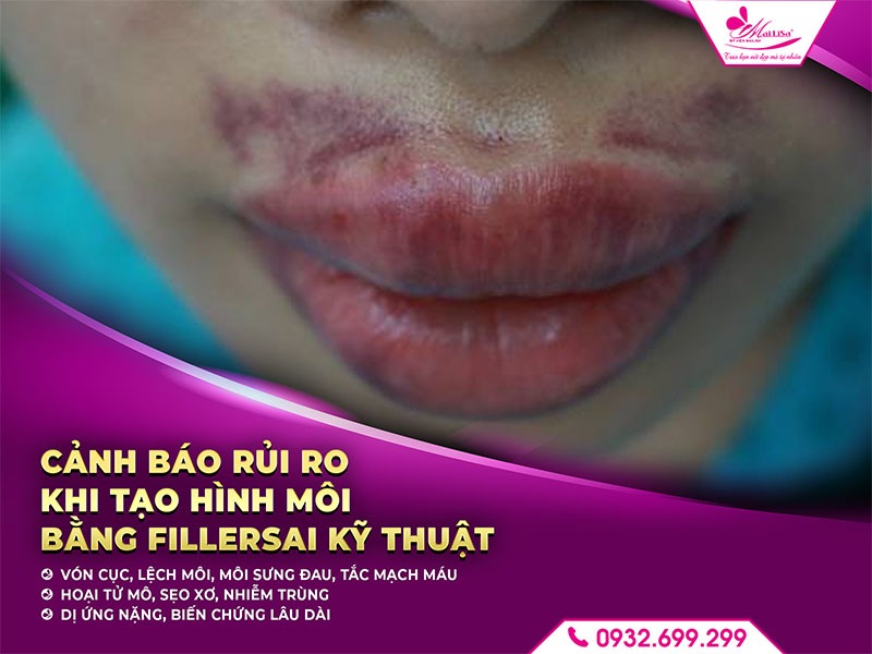 lam-dep-filler-moi-co-an-toan-khong
