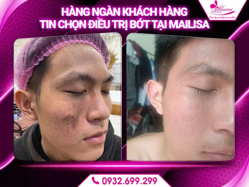 laser-tri-bot-sac-to-co-an-toan-khong