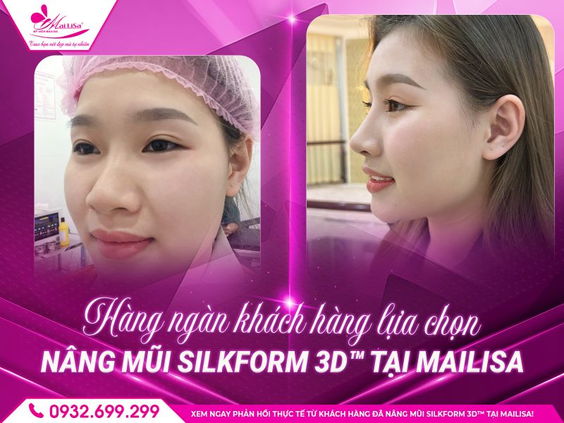 quy-trinh-nang-mui-silkform-3d™